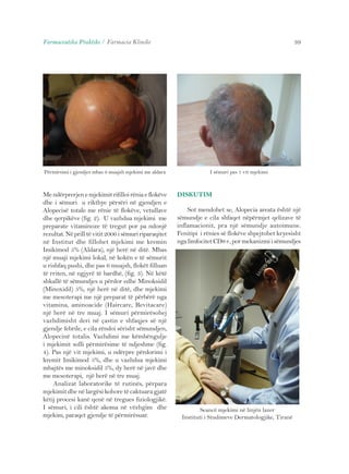 Farmaceutika Praktike / Farmacia Klinike 39 
Përmirsimi i gjendjes mbas 6 muajsh mjekimi me aldara I sëmuri pas 1 vit mjekimi 
Me ndërprerjen e mjekimit rifilloi rënia e flokëve 
dhe i sëmuri u rikthye përsëri në gjendjen e 
Alopecisë totale me rënie të flokëve, vetullave 
dhe qerpikëve (fig. 2). U vazhdua mjekimi me 
preparate vitaminoze të tregut por pa ndonjë 
rezultat. Në prill të vitit 2006 i sëmuri riparaqitet 
në Institut dhe fillohet mjekimi me kremin 
Imikimod 5% (Aldara), një herë në ditë. Mbas 
një muaji mjekimi lokal, në kokën e të sëmurit 
u rishfaq pushi, dhe pas 6 muajsh, flokët filluan 
të rriten, në ngjyrë të bardhë, (fig. 3). Në këtë 
shkallë të sëmundjes u përdor edhe Minoksidil 
(Minoxidil) 5%, një herë në ditë, dhe mjekimi 
me mesoterapi me një preparat të përbërë nga 
vitamina, aminoacide (Haircare, Revitacare) 
një herë në tre muaj. I sëmuri përmirësohej 
vazhdimisht deri në çastin e shfaqjes së një 
gjendje febrile, e cila rëndoi sërisht sëmundjen, 
Alopecinë totalis. Vazhdimi me këmbëngulje 
i mjekimit solli përmirësime të ndjeshme (fig. 
4). Pas një vit mjekimi, u ndërpre përdorimi i 
kremit Imikimod 5%, dhe u vazhdua mjekimi 
mbajtës me minoksidil 5%, dy herë në javë dhe 
me mesoterapi, një herë në tre muaj. 
Analizat laboratorike të rutinës, përpara 
mjekimit dhe në largësi kohore të caktuara gjatë 
këtij procesi kanë qenë në tregues fiziologjikë. 
I sëmuri, i cili është akoma në vëzhgim dhe 
mjekim, paraqet gjendje të përmirësuar. 
DISKUTIM 
Sot mendohet se, Alopecia areata është një 
sëmundje e cila shfaqet nëpërmjet qelizave të 
inflamacionit, pra një sëmundje autoimune. 
Fenitipi i rënies së flokëve shpejtohet kryesisht 
nga limfocitet CD8+, por mekanizmi i sëmundjes 
Seancë mjekimi në linjën lazer 
Instituti i Studimeve Dermatologjike, Tiranë 
 