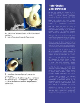 Referências
Bibliográficas
 
Di Fiore PM, Genov KA, Komaroff E, Li Y,
Lin L (2006) Nickel-titanium rotary instrument
fracture: a clinical practice assessment.
International Endodontic Journal 39, 700–8.
Eleazer PD, O’Connor RP.I (1999) nnovative
uses for hypodermic needles in endodontics.
Journal of Endodontics. 25(3):190-1.
Iqbal MK, Kohli MR, Kim JS (2006) A
retrospective clinical study of incidence of root
canal instrument separation in an endodontics
graduate program: a PennEndo database
study. Journal of Endodontics 32, 1048–52.
McGuigan MB, Louca C, Duncan HF (2013)
Clinical decision-making after endodontic instrument
fracture. British Dental Journal,214, 8, 395-400.
Murad M, Murray C (2011) Impact of retained
separated endodontic instruments during root canal
treatment on clinical outcomes remains uncertain.
Journal of Evidence Based Dental Practice 11, 87–8.
Panitvisai P, Parunnit P, Sathorn C, Messer
HH (2010) Impact of a retained instrument on
treatment outcome: a systematic review and meta-
analysis. Journal of Endodontics 36, 775–80.
Shen Y, Coil JM, McLean AG, Hemerling
DL, Haapasalo M (2009) Defects in nickel-
titanium instruments after clinical use. Part
5: single use from endodontic specialty
practices. Journal of Endodontics 35, 1363–7.
Tu MG, Chen SY, Huang HL, Tsai CC (2008)
Endodontic shaping performance using nickel-
titanium hand and motor ProTaper systems
by novice dental students. Journal of the
Formosan Medical Association 107, 381–8.
Tzanetakis GN, Kontakiotis EG, Maurikou
DV, Marzelou MP (2008) Prevalence and
management of instrument fracture in the
postgraduate endodontic program at the Dental
School of Athens: a 5-year retrospective clinical
study. Journal of Endodontics 34, 675–8.
Ungerechts C, B_ardsen A, Fristad I. (2014)
Instrument fracture in root canals – where, why,
when and what? A study from a student clinic.
International Endodontic Journal, 47, 183–190.
A – identificação radiográfica de instrumento
fraturado;
B – identificação clínica do fragmento
C – cânula e cianoacrilato e fragmento
removido;
D – visão clínica da câmara pulpar e entrada
dos canais após a remoção do fragmento;
E – instrumento fraturado e fragmento da
parte ativa.
 