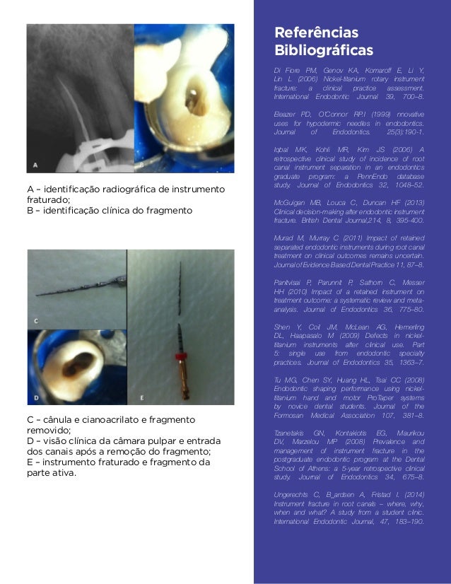 Alternativa para remoção de instrumento fraturado – Descrição de caso - FFO 