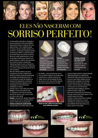 O sorriso perfeito dado pela cor, disposição e
forma dos dentes de muitas personalidades
famosas internacionais e nacionais nâo é uma
dádiva de Deus , e sim o trabalho baseado
em ciência e arte dos cirurgiões dentistas em
transformar características indesejáveis dentais
em pérolas que refletem o estado de espírito.
Esta transformação ocorre devido às lâminas
(lentes de contato dental), facetas ou coroas
em porcelana (cerâmica) que sofreram uma
grande evolução nos últimos anos permitindo
que uma leve e pequena camada deste
material seja fixada em parte ou totamente à
superfície dentária remanescente, melhorando
a cor , forma e disposição dos dentes de forma
mais harmoniosa.
Além das melhoras estéticas do sorriso
conseguimos aumentar a resistência dos
dentes que sofreram perda de esmalte dental
por desgaste natural, alterando a forma e
a cor dos dentes os quais não respodem ao
tratamento de clareamento convencional
ou ainda tratamentos terapêuticos como;
restaurações em resina, tratamentos
endodônticos e traumas.
Entenda o que é e como é feito este trabalho:
Coroas: o remanescente dental sofre
um desgaste em toda volta da superfície
aparente do dente ou seja a coroa recobre
por inteiro a área dental.
Facetas:o remanescente dental é desgastado
em torno de 2/4 a 3/4 e o recobrimento em
cerâmica é feito desta área desgastada.
Lâminasoulentesdecontatodental:
Gostaria de fazer uma resalva sobre este tipo
de trabalho, muitos pacientes que vem ao
meu consultório imaginam que simplesmente
confecionamos e colamos as lâminas sem
realizar nenhum tipo de desgaste do dente,
isto ocorre em raros casos. Um leve desgaste
deve ocorrer para que não crie um sobre
contorno (degrau) próximo a gengiva gerando
inflamação gengival com sangramento.
Infelizmente muitos pacientes novos que me
procuram é para refazer trabalhos que não
obtiveram bons resultados com este fator.
Princípio básico da física, dois corpos não
ocupam o mesmo espaço, ou seja, devolver
uma estrutura com cor e forma nova
respeitando espaços biológicos naturais é
fundamental para a sáude bucal.
Retornamos esclarecendo que as lâminas ou
lentes de contato dental recobre apenas 1/4 da
superfície aparente do dente.
Acredite, os mesmos tratamentos e materiais
utilizados para transformar um sorriso
imperfeito em um belo sorriso como das
personalidades destas fotos estão ao seu
alcance aqui em nossa cidade.
Eles não nasceram com
Coroas:o remanescente
dental sofre um
desgaste em toda volta
da superfície aparente
do dente ou seja a coroa
recobre por inteiro a
área dental.
Facetas:o
remanescente dental
é desgastado em
torno de 2/4 a 3/4 e
o recobrimento em
cerâmica é feito desta
área desgastada.
Lâminasoulentes
decontatodental:
O remanescente
dental pode não sofrer
desgaste ou apenas
1/4 da superfície será
removido.
Márcio
Fernandes
Cirurgião Dentista
Márcio
Fernandes
Cirurgião Dentista
Mudesuavida,melhoresuaautoestima,
sorriarefletindosuaalma!
sorriso perfeito!
 