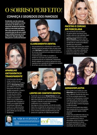 Natelevisão,umadascoisasque
maisnoschamaatençãoéosorriso
dosfamosos.Osdentescomacor
impecável,devidamentealinhados,
dandoaorostoaindamaisbeleza.
Maséclaroqueparatê-losassimé
necessárioestaremdiacomasaúde
bucaletambémbuscarporumbom
profissional.Vejaagoraalgumas
dicasparaterosorrisodosfamosos!
Comessatécnicavocêvaiconseguir
nãoapenasdentesmaisbrancos,como
tambémuniformesebemalinhados.Quem
éadeptaaesseprocedimentoéaatriz
FláviaAlessandra.Asfacetasnadamais
sãodoquelâminasfeitasdeporcelanaque
sãofabricadasdemaneirapersonalizadae
específicaparacadapaciente.
São necessárias, pelo menos, duas sessões:
uma para moldar os dentes, fazer exames
e tirar fotos, e outra para a colocação das
facetas de porcelana. Isso é bem rápido,
durando em média duas semanas.
Quem assistir a uma novela com a atriz
GlóriaPiresagora e há uns 20 anos vai
notar a diferença. Quando ela sorria, cerca
de 70% da sua gengiva aparecia. Isso
acontece com muitas pessoas e o excesso
de gengiva pode ser facilmente sanado
com a gengivoplastia. Um procedimento
cirúrgico que refaz o contorno da gengiva
ao redor dos dentes.
Como você mesmo pode notar, existem
várias maneiras de ter um sorriso perfeito
com procedimentos rápidos e de fácil
adaptação.
E todos estes procedimentos estão ao seu
alcance em nossa clínica, desenvolvida
com a experiência de 27 anos na
odontologia, sempre buscando o melhor
para nossos pacientes em ciência,
tecnologia e principalmente a arte na
reconstrução de um sorriso perfeito.
4PósGraduadonaAlemanhapeloZahnärtekammerNordhein(Düsseldorf),em1993
4 MestreemReabilitaçãoBucal(áreaqueenvolveestética,implantes,prótesedental
eperiodontia)
4 3especialidades
4 AtendepacientesdePontaGrossa,regiãodosCamposGerais,EUAeEuropa
Dr. Márcio Fernandes Rua México, 64 -
Estrela, Ponta Grossa -
Telefone: (42) 3224-2848Cirurgião Dentista
O SORRISO PERFEITO!
CONHEÇA 5 SEGREDOS DOS FAMOSOS
FACETAS E COROAS
EM PORCELANA
GENGIVOPLASTIA
Esse procedimento já é conhecido por muitos e você
também já pode ter pensado em fazer um assim, como
o ator CaioCastro. Na verdade, a maioria dos famosos
faz esse tipo de procedimento para deixar os dentes com
uma cor impecável.
O tratamento pode ser feito no consultório ou
também em casa (neste caso, também precisa do
acompanhamento de um profissional). O clareamento
dental é realizado com o uso de um gel que tem como
ingrediente base o peróxido de hidrogênio, e/ou também
de um laser, que potencializa o efeito.
CLAREAMENTO DENTAL
É uma forma bem discreta de
corrigir os dentes sem que
ninguém perceba. Foi o escolhido
pela atriz FernandaPaesLeme
para melhorar o sorriso. Existem,
basicamente, dois tipos de
aparelho transparente: o móvel (o
escolhido pela atriz) e o fixo.
A função dos dois é alinhar
os dentes. O fixo é como um
aparelho convencional de
metal, só que completamente
transparente (fios e braquetes). O
móvel é uma unidade facilmente
removível que é fabricada de
acordo com o molde dos dentes
do paciente. Ele é mais indicado
para os dentes que não são muito
desalinhados.
Aquele belo sorriso do ator GeorgeClooneynão é por
acaso. Ele é adepto das lentes de contato dental. A função
deles é bem parecida com a da faceta de porcelana
e também é colocado na parte frontal do dente,
modificando a cor e o tamanho dele.
Após algumas visitas ao dentista, cerca de três consultas
depois (isso vai depender de cada pessoa, esse número é
apenas uma média) você já vai poder mostrar o seu belo
sorriso. As lentes são feitas especificamente para cada
pessoa com a ajuda de um molde feito pelo dentista.
APARELHO
ORTODÔNTICO
TRANSPARENTE
LENTES DE CONTATO DENTAL
 
