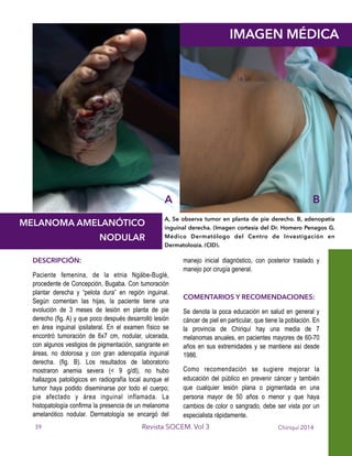 !
!
!
!
!
!
!
!
!
!
!
!
!
!
!
!
DESCRIPCIÓN:
Paciente femenina, de la etnia Ngäbe-Buglé,
procedente de Concepción, Bugaba. Con tumoración
plantar derecha y “pelota dura” en región inguinal.
Según comentan las hijas, la paciente tiene una
evolución de 3 meses de lesión en planta de pie
derecho (fig. A) y que poco después desarrolló lesión
en área inguinal ipsilateral. En el examen físico se
encontró tumoración de 6x7 cm, nodular, ulcerada,
con algunos vestigios de pigmentación, sangrante en
áreas, no dolorosa y con gran adenopatía inguinal
derecha. (fig. B). Los resultados de laboratorio
mostraron anemia severa (< 9 g/dl), no hubo
hallazgos patológicos en radiografía local aunque el
tumor haya podido diseminarse por todo el cuerpo;
pie afectado y área inguinal inflamada. La
histopatología confirma la presencia de un melanoma
amelanótico nodular. Dermatología se encargó del
manejo inicial diagnóstico, con posterior traslado y
manejo por cirugía general.
!
COMENTARIOS Y RECOMENDACIONES:
Se denota la poca educación en salud en general y
cáncer de piel en particular, que tiene la población. En
la provincia de Chiriquí hay una media de 7
melanomas anuales, en pacientes mayores de 60-70
años en sus extremidades y se mantiene así desde
1986.
Como recomendación se sugiere mejorar la
educación del público en prevenir cáncer y también
que cualquier lesión plana o pigmentada en una
persona mayor de 50 años o menor y que haya
cambios de color o sangrado, debe ser vista por un
especialista rápidamente.
Chiriquí 2014Revista SOCEM. Vol 3
!
!
MELANOMA AMELANÓTICO
NODULAR
A, Se observa tumor en planta de pie derecho. B, adenopatía
inguinal derecha. (Imagen cortesía del Dr. Homero Penagos G.
Médico Dermatólogo del Centro de Investigación en
Dermatología. (CID).
IMAGEN MÉDICA
39
A B
 