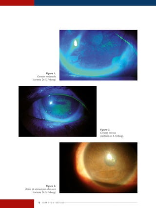 12 Volume 02 | No
02 | agosto/2013
Figura 1.
Ceratite moderada
(cortesia Dr. S. Felberg).
Figura 2.
Ceratite intensa
(cortesia Dr. S. Felberg).
Figura 3.
Úlcera de córnea por olho seco
(cortesia Dr. S. Felberg).
 