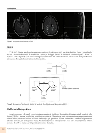 Esclerose múltipla 
Figura 2. Imagens de RMN cerebral do Caso 1. 
Caso 2 
V.L.P.M.C., 28 anos, sexo feminino, caucasiana, assistente dentária, com o 12º ano de escolaridade. Pertence a uma família 
nuclear e altamente funcional, de acordo com a aplicação do Apgar familiar de Smilkstein, constituída por V.L.P.M.C., o 
marido e a filha (Figura 3). Sem antecedentes pessoais relevantes. Em termos familiares, o marido tem doença de Crohn e 
a irmã, uma doença inflamatória intestinal inespecífica. 
Figura 3. Genograma e Psicofigura de Mitchell da família do Caso 2 (realizado a 14 de maio de 2012). 
História da Doença Atual 
A paciente recorre à demanda espontânea da sua médica de família por diminuição súbita da acuidade visual do olho 
direito (OD) há 1 semana. Já tinha sido atendida pelo serviço de Oftalmologia, onde realizou estudo de campos visuais, que 
revelou defeito obliterante inferior do OD e fundoscopia que apresentou no OD “crowded disc” com bordas ligeiramente 
esbatidas (borradas, em português do Brasil). Ao exame objetivo do olho apresentava visão turva no campo visual inferior 
esquerdo do OD. O exame neurológico não apresentava alterações. 
368 Rev Bras Med Fam Comunidade. Rio de Janeiro, 2014 Out-Dec; 9(33):365-370. 
 