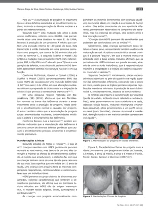 119
Ter Man. 2012; 10(47):117-122
Mariane Braga da Silva, Gizele Fontana Costalonga, Hélio Gustavo Santos.
Para Liu(14)
a acumulação de progerin no organismo
leva a vários defeitos associados ao envelhecimento nu-
clear, incluindo a desorganização da lâmina nuclear e a
perda de heterocromatina.
Segundo Cao(15)
esta mutação não afeta o ácido
amino codiﬁcados, referido como G608G, mas parcial-
mente ativa uma área doadora no exon 11 do LMNA,
levando à produção de um prelamin A mRNA que con-
tém uma exclusão interna de 150 pares de base. Esta
transcrição é então traduzida em uma proteína conhe-
cida como progerin, que carece de 50 aminoácidos pró-
ximo ao terminal C. E segundo Scafﬁdi e Misteli (30)
(2006) a mutação mais prevalente HGPS (Gly heterozi-
gotos 608 Gly 608 com C alterado para T) leva a uma
geração de defeitos, e as células do paciente HGPS tam-
bém apresentam defeitos na estrutura nuclear e em sua
função.
Conforme McClintock, Gordon e Djabali (2006) e
Scafﬁdi e Misteli (2005) aproximadamente 80% dos
casos HGPS são causadas por uma mutação G608 (GGC
GGT) no exon 11 do LMNA, em que alterações nuclea-
res afetam a progressão do ciclo celular e a migração de
células o que provoca a senescência prematura(16,17)
.
Em uma pesquisa recente realizada por Bla-
gosklonny (18) (2011) aﬁrma-se que em ﬁbroblas-
tos normais os danos dos telômeros durante o enve-
lhecimento ativa a produção de progerin, neste cená-
rio o envelhecimento normal é causado por progerin.
O autor também relata que a acumulação de progerin
causa anormalidades nucleares, anormalidades mitóti-
cas e acelera o encurtamento dos telômeros.
Conforme Benson, Lee e Aaronson(19)
existem evi-
dências indicando que a manutenção dos telômeros é
um alvo comum de diversos defeitos genéticos que cau-
sam o envelhecimento precoce, síndromes e envelheci-
mento prematuro.
Manifestações Clínicas
Segundo estudos de Pollex e Helege(20)
, e Cao et
al(21)
crianças nascidas com HGPS geralmente parecem
normais ao nascimento, mas dentro de um ano eles co-
meçam a mostrar os efeitos do envelhecimento acelera-
do. À medida que amadurecem, o distúrbio faz com que
as crianças tenham cerca de uma década para cada ano
de sua vida. Isso signiﬁca que em média de 10 anos de
idade, uma criança com progéria teria as mesmas com-
plicações respiratórias, cardiovasculares e osteomuscu-
lares que um indivíduo idoso.
HGPS pertence ao grupo distinto de síndromes pro-
geróides, exibindo características que lembram a se-
nescência prematura, ele aﬁrma que os principais te-
cidos afetados em HGPS são de origem mesenqui-
mal, e incluem tecido adiposo, ósseo, cartilaginoso e
cardiovascular(22)
.
As crianças com progéria emocionalmente com-
partilham os mesmos sentimentos com crianças saudá-
veis da mesma idade em relação à expressão de humor
e afeto. Elas estão conscientes de sua aparência dife-
rente, permanecem reservados na companhia de estra-
nhos, mas na presença de amigos, eles exibem afeto e
boa interação social(23)
.
“Crianças com HGPS parecem tão semelhantes que
poderiam ser confundidos com os irmãos”(10)
.
Geralmente, estas crianças apresentam baixa es-
tatura e baixo peso, apresentando também ausência da
maturação sexual. A postura característica dessas crian-
ças é a postura “equina”, em que a marcha mostra-se
arrastada com a base ampla. Estudos aﬁrmam que os
portadores de HGPS eliminam em grande excesso, atra-
vés da urina o ácido hialurônico, que é responsável por
mantém a integridade e a textura do sistema esqueléti-
co, muscular e vascular(5)
.
Segundo Coutinho(24)
inicialmente, placas esclero-
dérmicas aparecem na pele do quadril e na região supe-
rior das extremidades inferiores, colocando todo o corpo
em risco, exceto para os órgãos genitais e algumas regi-
ões dos membros inferiores. A produção de suor é dimi-
nuída e, simultaneamente, alopecia se torna evidente.
O fenótipo da progéria é caracterizado por alopecia
(perda de cabelo, incluindo couro cabeludo e sobrance-
lhas), veias proeminentes no couro cabeludo e na testa,
clássicos traços faciais, incluindo micrognatia (mandí-
bula pequena), olhos proeminentes e um perﬁl conve-
xo nasal (nariz bico-like), cianose circumoral e nasola-
bial, dentição tardia e em maioria também apresentam
voz aguda(2)
.
Figura 1. Manifestações da progéria em idades diferentes.
Figura 1, Características físicas da progéria com a
idade.Uma menina com progeria em idades de 3 meses,
13 meses, 3 anos 11 meses, 6 anos e 6 meses e 9 anos.
Fonte: Kieran, Gordon e Kleinman (2007) (2)
Figura 2. Manifestações Clínicas da Progéria.
 