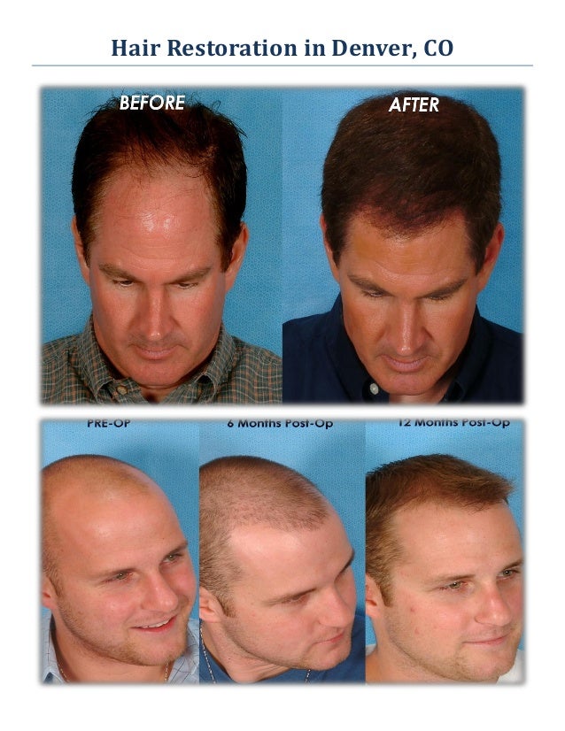 Revive Hair Transplant Denver