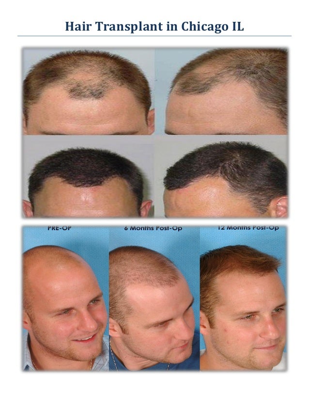 Revive Hair Transplant in Chicago IL