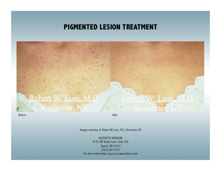Dr. Darm Melasma and Tattoo Removal