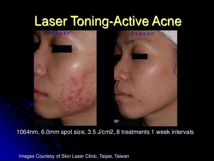 revlite for acne