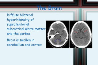 Ammonia infects the brain