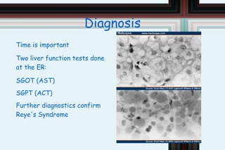 Causes Exact cause unknown