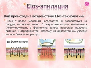 Как происходит воздействие Elos-технологии?
*Пигмент волос (меланин) нагревается, и воздействует на
сосуды, питающие волос. В результате сосуды запаиваются
(коагулируются), а фолликула волоса перестает получать
питание и атрофируется. Поэтому на обработанном участке
волосы больше не растут.
*
 