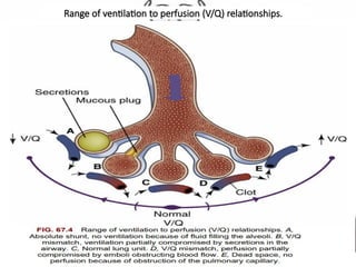 Range of ventilation to perfusion (V/Q) relationships.
 