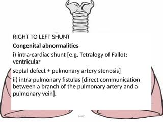 RIGHT TO LEFT SHUNT
Congenital abnormalities
i) intra-cardiac shunt [e.g. Tetralogy of Fallot:
ventricular
septal defect + pulmonary artery stenosis]
ii) intra-pulmonary fistulas [direct communication
between a branch of the pulmonary artery and a
pulmonary vein].
11/23/2024 MsRC 33
 