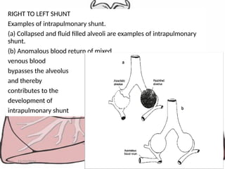 RIGHT TO LEFT SHUNT
Examples of intrapulmonary shunt.
(a) Collapsed and fluid filled alveoli are examples of intrapulmonary
shunt.
(b) Anomalous blood return of mixed
venous blood
bypasses the alveolus
and thereby
contributes to the
development of
intrapulmonary shunt
11/23/2024 MsRC 35
 