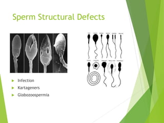 Sperm Structural Defects
 Infection
 Kartageners
 Globozoospermia
 