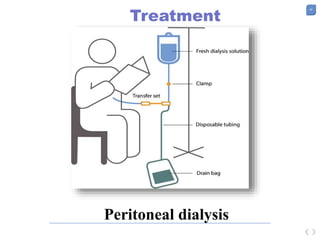 40
Treatment
Peritoneal dialysis
 
