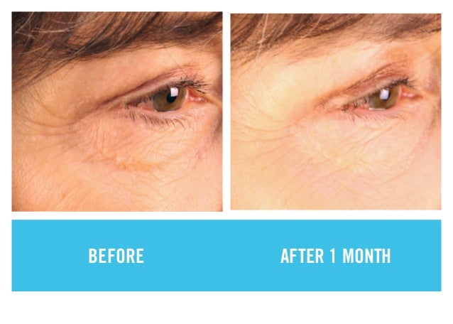 rodan fields eye cream