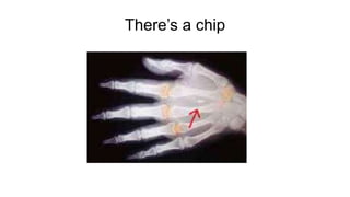 There’s a chip
 