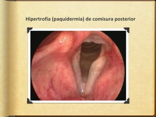 Hipertrofia (paquidermia) de comisura posterior
 