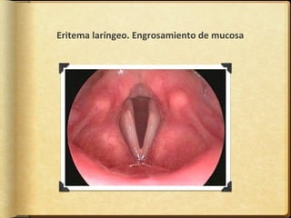 Eritema laríngeo. Engrosamiento de mucosa
 