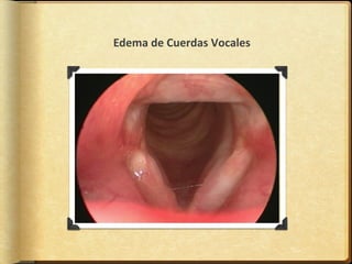 Edema de Cuerdas Vocales
 