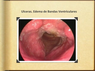 Ulceras. Edema de Bandas Ventriculares
 