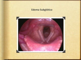 Edema Subglótico
 