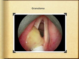 Granuloma
 