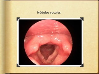 Nódulos vocales
 