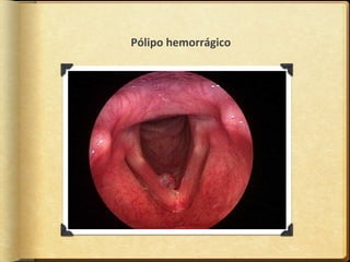 Pólipo hemorrágico
 