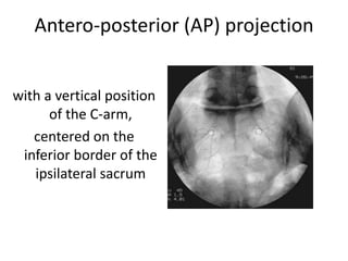 Antero-posterior (AP) projection
with a vertical position
of the C-arm,
centered on the
inferior border of the
ipsilateral sacrum
 