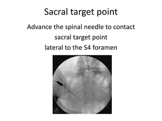 Sacral target point
Advance the spinal needle to contact
sacral target point
lateral to the S4 foramen
 