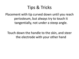Tips & Tricks
Placement with tip curved down until you reach
periosteum, but always try to touch it
tangentially, not under a steep angle.
Touch down the handle to the skin, and steer
the electrode with your other hand
 