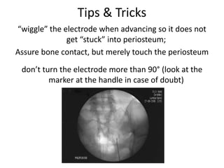 Tips & Tricks
“wiggle” the electrode when advancing so it does not
get “stuck” into periosteum;
Assure bone contact, but merely touch the periosteum
don’t turn the electrode more than 90° (look at the
marker at the handle in case of doubt)
 