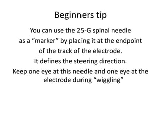 Beginners tip
You can use the 25-G spinal needle
as a “marker” by placing it at the endpoint
of the track of the electrode.
It defines the steering direction.
Keep one eye at this needle and one eye at the
electrode during “wiggling”
 
