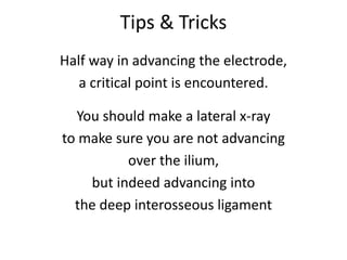 Tips & Tricks
Half way in advancing the electrode,
a critical point is encountered.
You should make a lateral x-ray
to make sure you are not advancing
over the ilium,
but indeed advancing into
the deep interosseous ligament
 