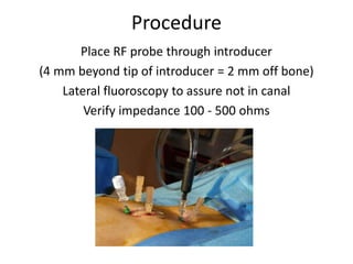 Procedure
Place RF probe through introducer
(4 mm beyond tip of introducer = 2 mm off bone)
Lateral fluoroscopy to assure not in canal
Verify impedance 100 - 500 ohms
 