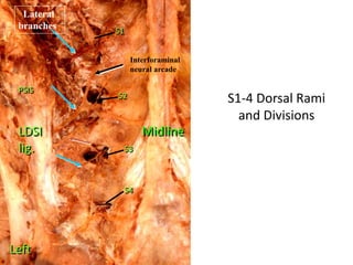 S1-4 Dorsal Rami
and Divisions
Midline
PSIS
S1
S2
S3
S4
Left
LDSI
lig.
Interforaminal
neural arcade
Lateral
branches
 