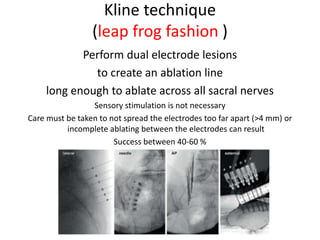 Kline technique
(leap frog fashion )
Perform dual electrode lesions
to create an ablation line
long enough to ablate across all sacral nerves
Sensory stimulation is not necessary
Care must be taken to not spread the electrodes too far apart (>4 mm) or
incomplete ablating between the electrodes can result
Success between 40‐60 %
 