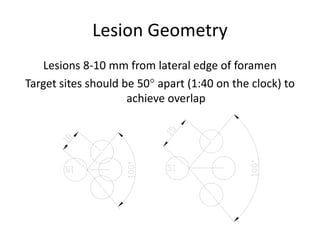 Lesion Geometry
Lesions 8-10 mm from lateral edge of foramen
Target sites should be 50° apart (1:40 on the clock) to
achieve overlap
 