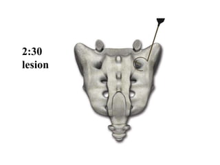 2:30
lesion
 