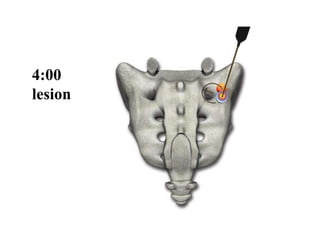 4:00
lesion
 