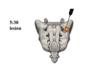5:30
lesion
 