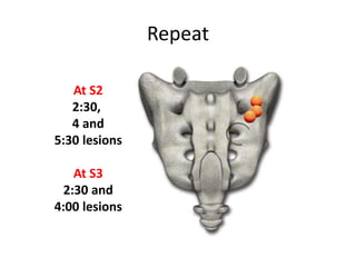 At S2
2:30,
4 and
5:30 lesions
At S3
2:30 and
4:00 lesions
Repeat
 