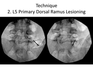 Technique
2. L5 Primary Dorsal Ramus Lesioning
 