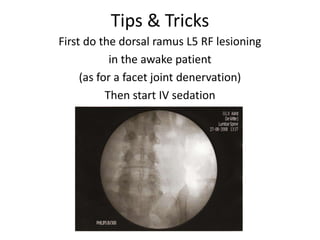 Tips & Tricks
First do the dorsal ramus L5 RF lesioning
in the awake patient
(as for a facet joint denervation)
Then start IV sedation
 