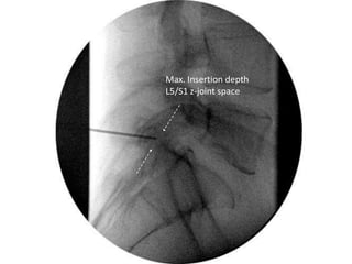 Max. Insertion depth
L5/S1 z-joint space
 