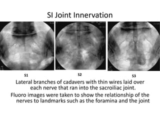 SI Joint Innervation
Lateral branches of cadavers with thin wires laid over
each nerve that ran into the sacroiliac joint.
Fluoro images were taken to show the relationship of the
nerves to landmarks such as the foramina and the joint
S1 S3S2
 