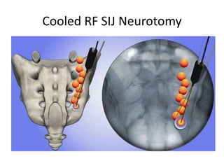 Cooled RF SIJ Neurotomy
 